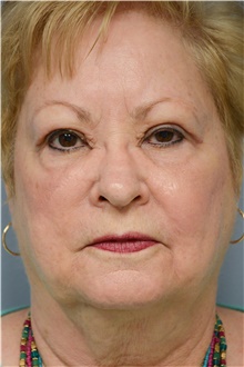 Eyelid Ptosis Repair After Photo by Carlos Rivera-Serrano, MD; Bay Harbour Islands, FL - Case 43677