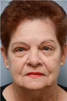Eyelid Ptosis Repair After Photo by Carlos Rivera-Serrano, MD; Bay Harbour Islands, FL - Case 43678