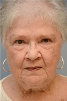 Eyelid Ptosis Repair After Photo by Carlos Rivera-Serrano, MD; Bay Harbour Islands, FL - Case 43679