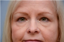 Eyelid Ptosis Repair After Photo by Carlos Rivera-Serrano, MD; Bay Harbour Islands, FL - Case 43680
