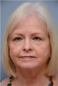 Eyelid Ptosis Repair After Photo by Carlos Rivera-Serrano, MD; Bay Harbour Islands, FL - Case 43680