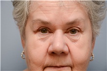 Eyelid Ptosis Repair After Photo by Carlos Rivera-Serrano, MD; Bay Harbour Islands, FL - Case 43681