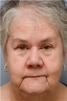 Eyelid Ptosis Repair After Photo by Carlos Rivera-Serrano, MD; Bay Harbour Islands, FL - Case 43681