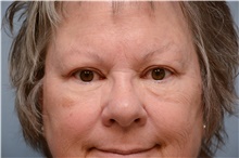 Eyelid Ptosis Repair After Photo by Carlos Rivera-Serrano, MD; Bay Harbour Islands, FL - Case 43682
