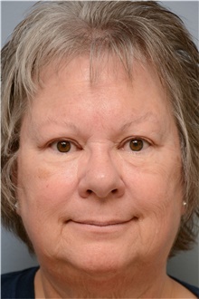 Eyelid Ptosis Repair After Photo by Carlos Rivera-Serrano, MD; Bay Harbour Islands, FL - Case 43682