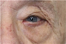 Eyelid Surgery After Photo by Carlos Rivera-Serrano, MD; Bay Harbour Islands, FL - Case 43684