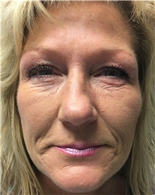 Eyelid Surgery Before Photo by Carlos Rivera-Serrano, MD; Bay Harbour Islands, FL - Case 43685