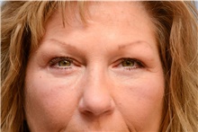 Eyelid Surgery After Photo by Carlos Rivera-Serrano, MD; Bay Harbour Islands, FL - Case 43685