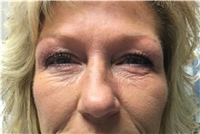 Eyelid Surgery Before Photo by Carlos Rivera-Serrano, MD; Bay Harbour Islands, FL - Case 43685