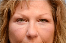 Eyelid Surgery After Photo by Carlos Rivera-Serrano, MD; Bay Harbour Islands, FL - Case 43685