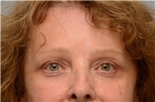 Eyelid Surgery After Photo by Carlos Rivera-Serrano, MD; Bay Harbour Islands, FL - Case 43686