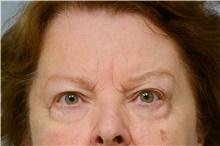 Eyelid Surgery Before Photo by Carlos Rivera-Serrano, MD; Bay Harbour Islands, FL - Case 43686