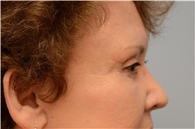 Eyelid Surgery After Photo by Carlos Rivera-Serrano, MD; Carbondale, IL - Case 43688