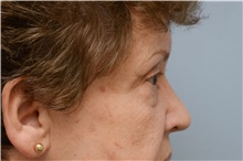 Eyelid Surgery Before Photo by Carlos Rivera-Serrano, MD; Carbondale, IL - Case 43688