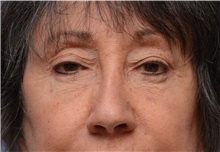 Eyelid Surgery After Photo by Carlos Rivera-Serrano, MD; Bay Harbour Islands, FL - Case 43689