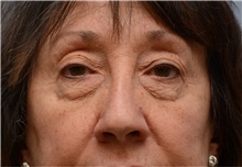 Eyelid Surgery Before Photo by Carlos Rivera-Serrano, MD; Bay Harbour Islands, FL - Case 43689