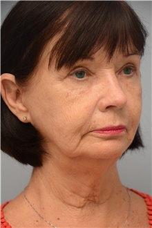 Eyelid Surgery After Photo by Carlos Rivera-Serrano, MD; Bay Harbour Islands, FL - Case 43690
