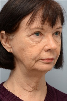 Eyelid Surgery Before Photo by Carlos Rivera-Serrano, MD; Bay Harbour Islands, FL - Case 43690