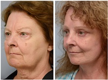 Facelift After Photo by Carlos Rivera-Serrano, MD; Bay Harbour Islands, FL - Case 43692