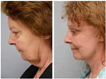 Facelift Before Photo by Carlos Rivera-Serrano, MD; Bay Harbour Islands, FL - Case 43692