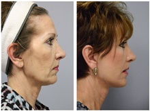 Facelift After Photo by Carlos Rivera-Serrano, MD; Bay Harbour Islands, FL - Case 43693
