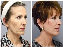 Facelift Before Photo by Carlos Rivera-Serrano, MD; Bay Harbour Islands, FL - Case 43693