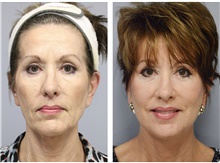 Facelift Before Photo by Carlos Rivera-Serrano, MD; Bay Harbour Islands, FL - Case 43693