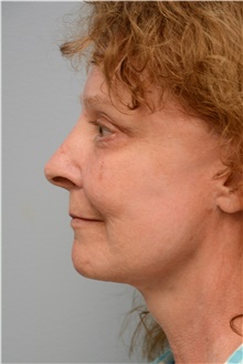 Facelift After Photo by Carlos Rivera-Serrano, MD; Bay Harbour Islands, FL - Case 43694