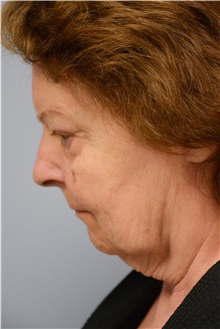 Facelift Before Photo by Carlos Rivera-Serrano, MD; Bay Harbour Islands, FL - Case 43694