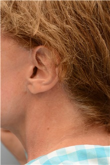 Facelift After Photo by Carlos Rivera-Serrano, MD; Bay Harbour Islands, FL - Case 43694