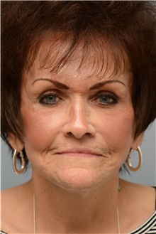 Facelift After Photo by Carlos Rivera-Serrano, MD; Bay Harbour Islands, FL - Case 43695