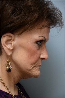 Facelift Before Photo by Carlos Rivera-Serrano, MD; Bay Harbour Islands, FL - Case 43695