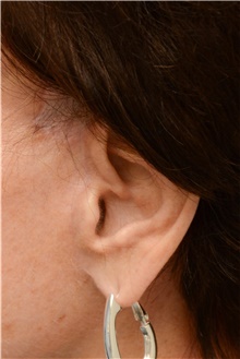 Facelift After Photo by Carlos Rivera-Serrano, MD; Bay Harbour Islands, FL - Case 43695