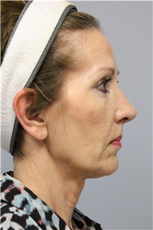 Facelift Before Photo by Carlos Rivera-Serrano, MD; Bay Harbour Islands, FL - Case 43697