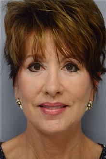 Facelift After Photo by Carlos Rivera-Serrano, MD; Bay Harbour Islands, FL - Case 43697