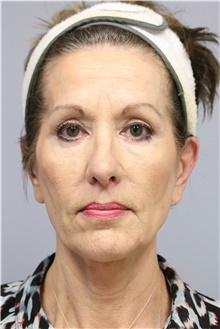 Facelift Before Photo by Carlos Rivera-Serrano, MD; Bay Harbour Islands, FL - Case 43697