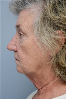 Facelift Before Photo by Carlos Rivera-Serrano, MD; Bay Harbour Islands, FL - Case 43698