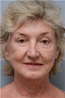 Facelift After Photo by Carlos Rivera-Serrano, MD; Bay Harbour Islands, FL - Case 43698