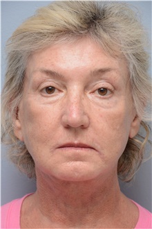 Facelift After Photo by Carlos Rivera-Serrano, MD; Bay Harbour Islands, FL - Case 43698