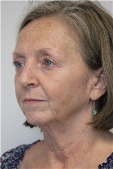 Facelift Before Photo by Carlos Rivera-Serrano, MD; Bay Harbour Islands, FL - Case 43699