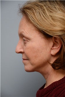 Facelift After Photo by Carlos Rivera-Serrano, MD; Bay Harbour Islands, FL - Case 43699