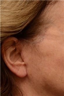 Facelift After Photo by Carlos Rivera-Serrano, MD; Bay Harbour Islands, FL - Case 43699