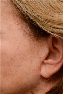 Facelift Before Photo by Carlos Rivera-Serrano, MD; Bay Harbour Islands, FL - Case 43699