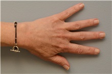 Hand Surgery After Photo by Carlos Rivera-Serrano, MD; Bay Harbour Islands, FL - Case 43702