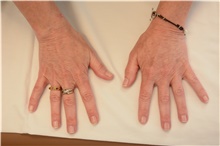 Hand Surgery After Photo by Carlos Rivera-Serrano, MD; Bay Harbour Islands, FL - Case 43702