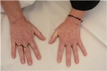 Hand Surgery Before Photo by Carlos Rivera-Serrano, MD; Bay Harbour Islands, FL - Case 43702