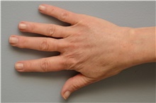 Hand Surgery After Photo by Carlos Rivera-Serrano, MD; Bay Harbour Islands, FL - Case 43703