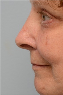 Injectable Fillers After Photo by Carlos Rivera-Serrano, MD; Bay Harbour Islands, FL - Case 43704