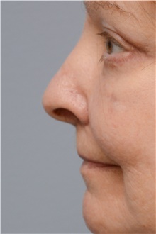 Injectable Fillers Before Photo by Carlos Rivera-Serrano, MD; Bay Harbour Islands, FL - Case 43704