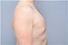Male Breast Reduction After Photo by Carlos Rivera-Serrano, MD; Bay Harbour Islands, FL - Case 43709